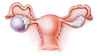 Eierstockzysten: oft harmlose Erscheinungen