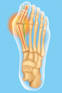 Hallux valgus: Wenn der Schuh drückt