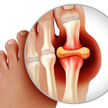 Diagnose Gicht: Das hilft dem Stoffwechsel